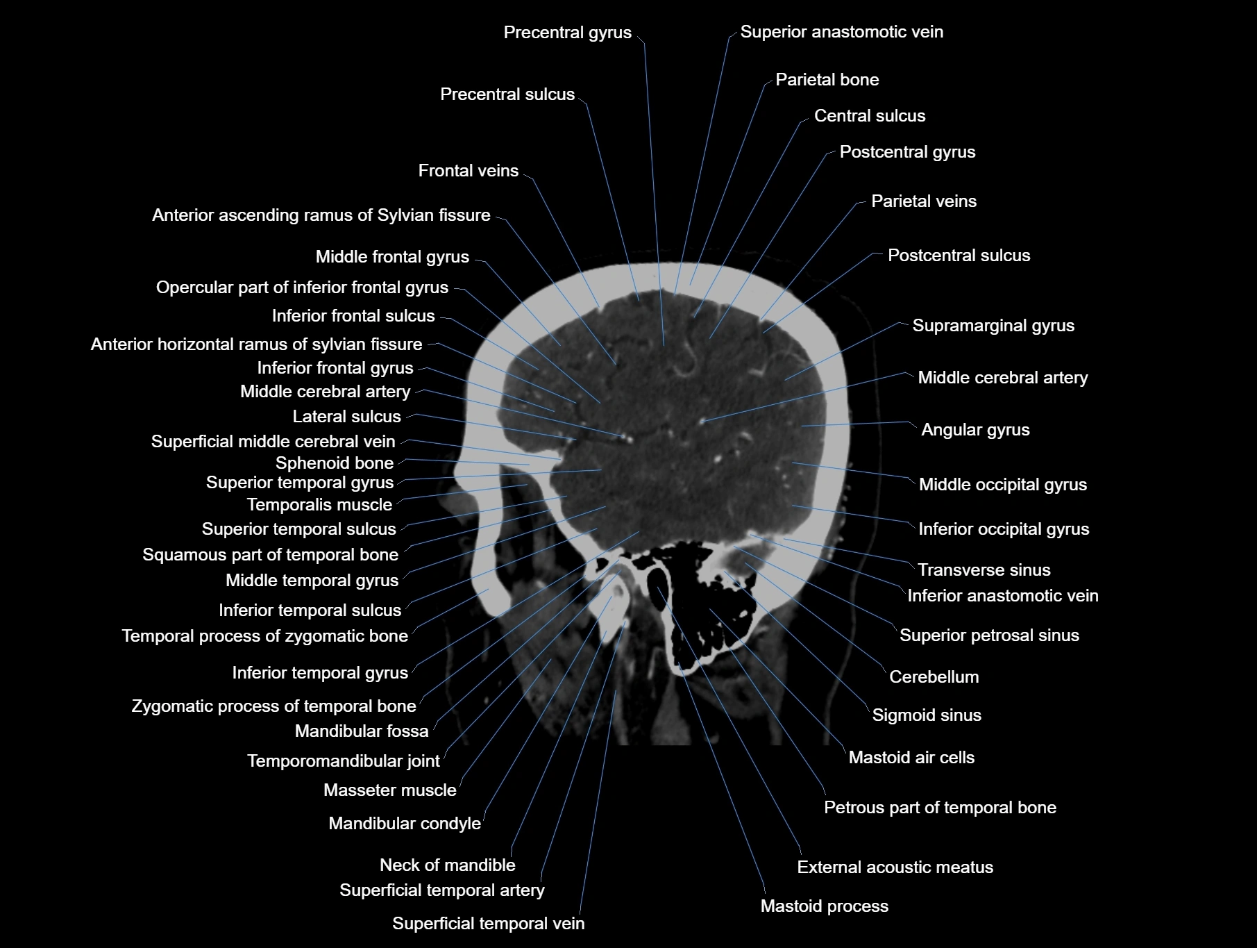 CT scan brain sagittal cross sectional anatomy image-img-00001-00015.webp